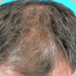 Hair Transplant