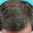 Hair Transplant