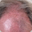 Hair Transplant