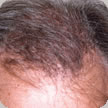 Hair Transplant