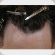 Hair Transplant