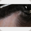 Hair Transplant