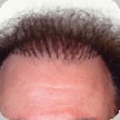 Hair Transplant