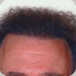 Hair Transplant