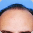 Hair Transplant