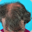 Hair Transplant