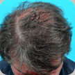 Hair Transplant