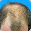 Hair Transplant