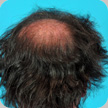 Hair Transplant