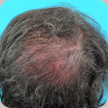 Hair Transplant