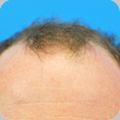 Hair Transplant