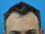 Hair Transplant