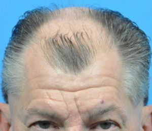 Hair Transplant