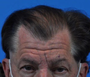 Hair Transplant