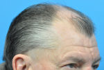 Hair Transplant