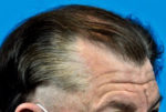 Hair Transplant