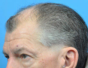 Hair Transplant