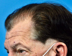 Hair Transplant