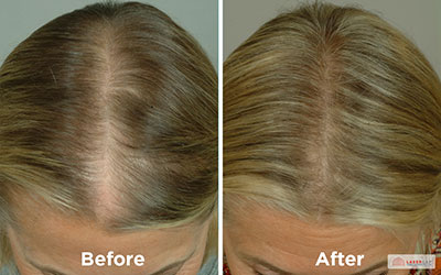 LaserCap before and after procedure