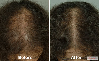 LaserCap before and after procedure