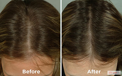 LaserCap before and after procedure