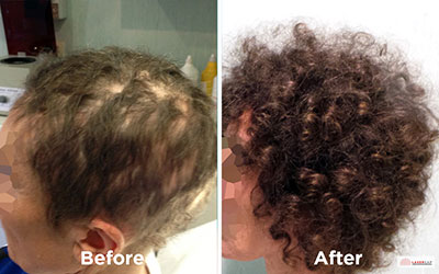 LaserCap before and after procedure