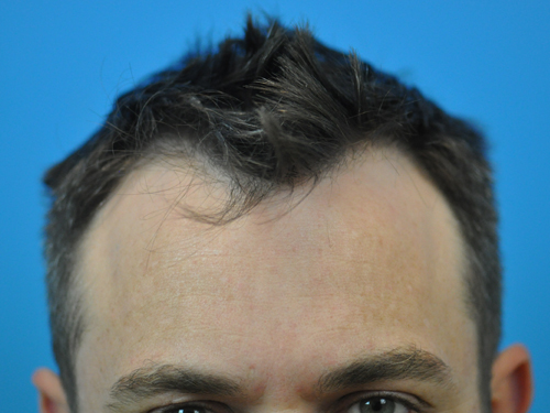 NeoGraft Follicular Unit Extraction (FUE) Hair Restoration Results Indianapolis