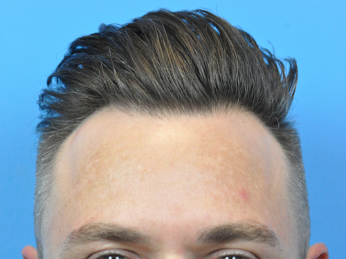 NeoGraft Follicular Unit Extraction (FUE) Hair Restoration Results Indianapolis