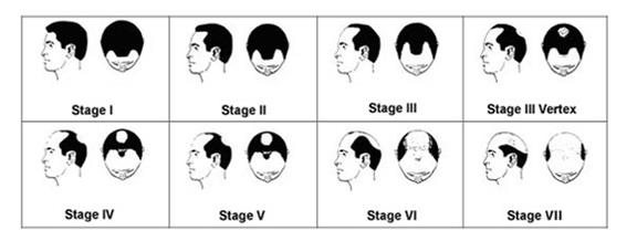 Hair Loss Classification Chart.
