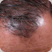 Hair Transplant