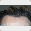 Hair Transplant