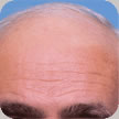 Hair Transplant