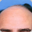 Hair Transplant