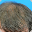 Hair Transplant
