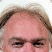 Hair Transplant