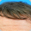 Hair Transplant