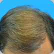 Hair Transplant