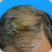 Hair Transplant