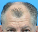 Hair Transplant